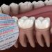 Niềng răng có được bảo hiểm y tế chi trả hay không?
